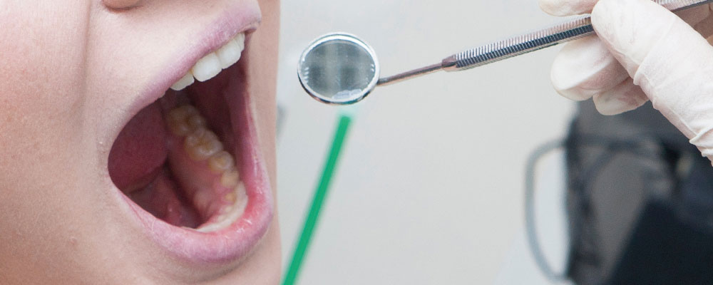 変色を伴う歯科治療のイメージ